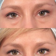 dr. brett kotlus eyelid bags non-surgical