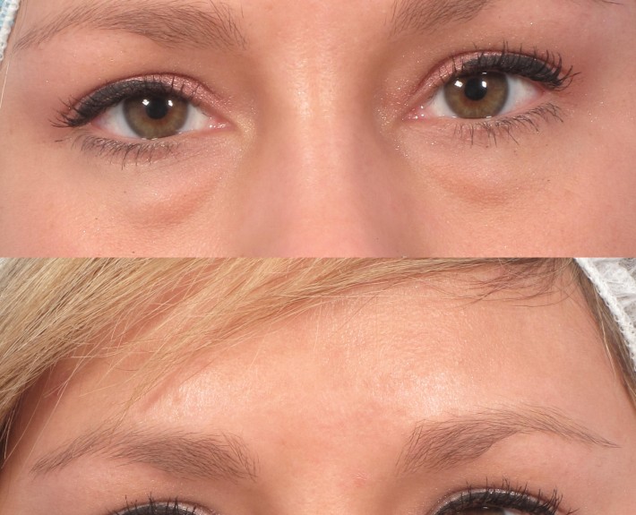 dr. brett kotlus eyelid bags non-surgical