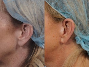 Dr. brett kotlus cosmetic oculoplastic nyc facelift scars