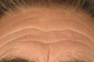 Dr. brett kotlus cosmetic oculoplastic forehead lines