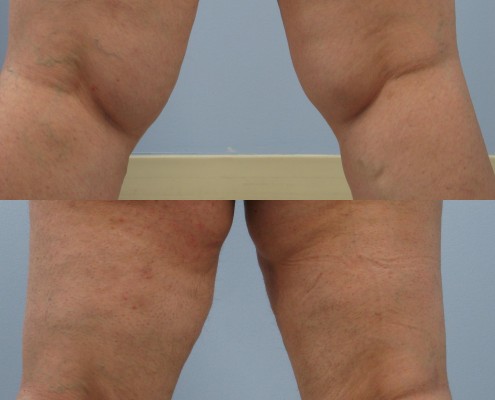 Dr. brett kotlus cosmetic oculoplastic inner knee lipo westchester