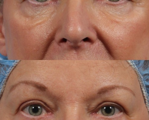 Dr. brett kotlus cosmetic oculoplastic upper eyelids female