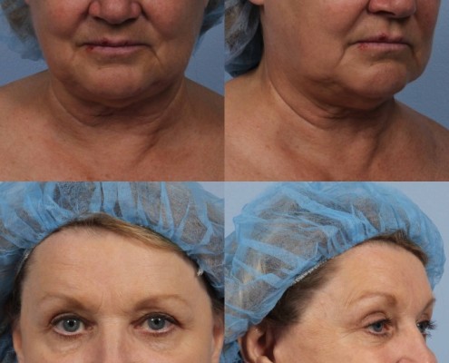 Dr. brett kotlus cosmetic oculoplastic facelift