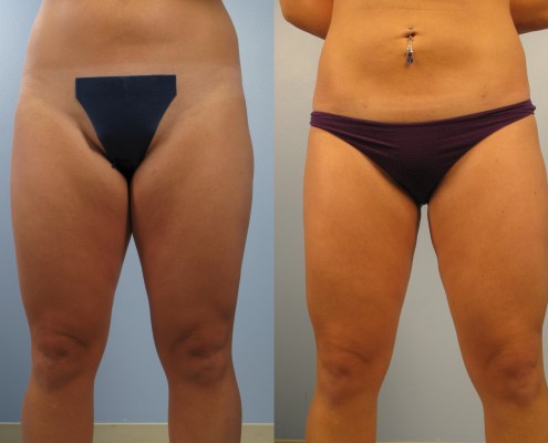 Dr. brett kotlus cosmetic oculoplastic thigh lipo