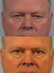 Dr. brett kotlus cosmetic oculoplastic upper blepharoplasty ny male