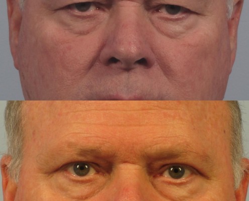 Dr. brett kotlus cosmetic oculoplastic upper blepharoplasty ny male