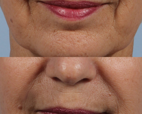 dr. brett kotlus juvederm