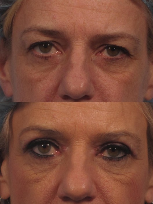 Dr. brett kotlus cosmetic oculoplastic blepharoplasty ny