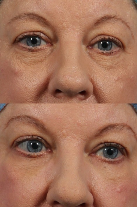 dr. brett kotlus eye lift bags