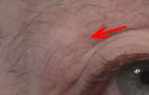 Dr. brett kotlus cosmetic oculoplastic lacrimal prolapse