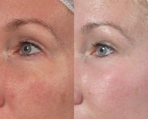 nyc skin laser resurfacing