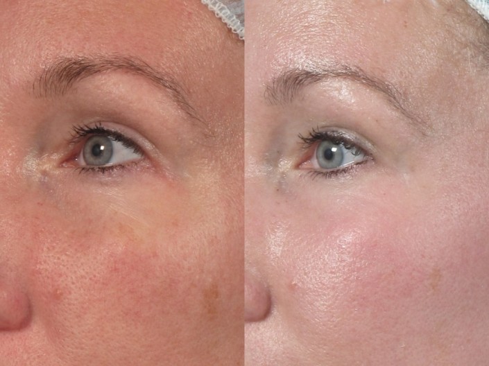 nyc skin laser resurfacing