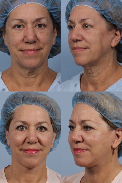 Dr. brett kotlus cosmetic oculoplastic necklift surgeon ny