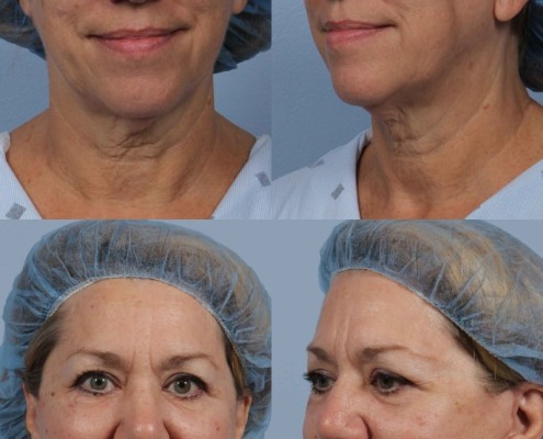 Dr. brett kotlus cosmetic oculoplastic necklift surgeon ny