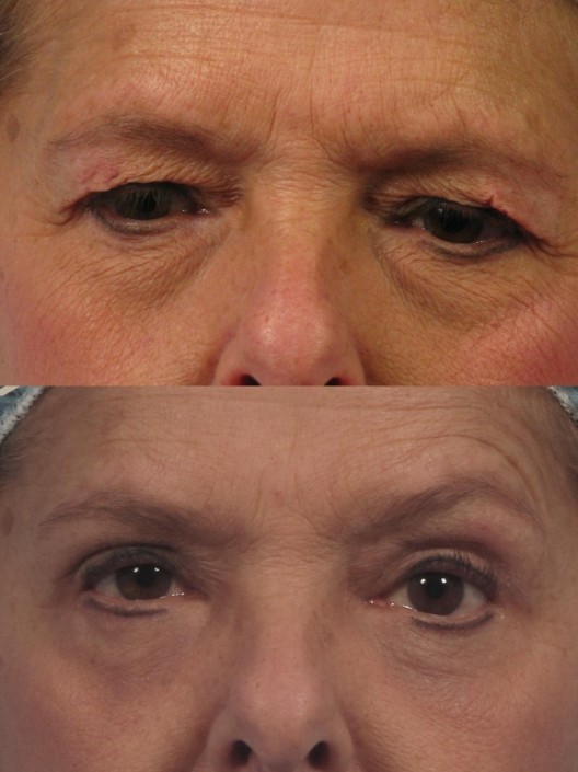 Dr. brett kotlus cosmetic oculoplastic blepharoplasty new york