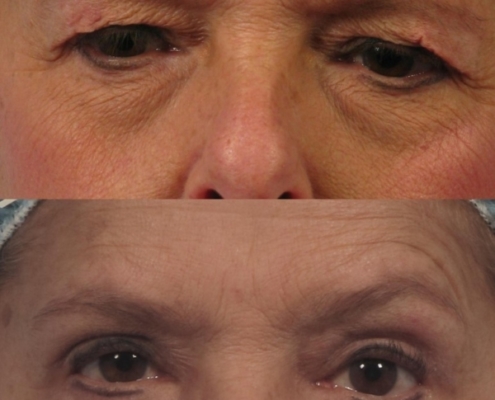 Dr. brett kotlus cosmetic oculoplastic blepharoplasty new york