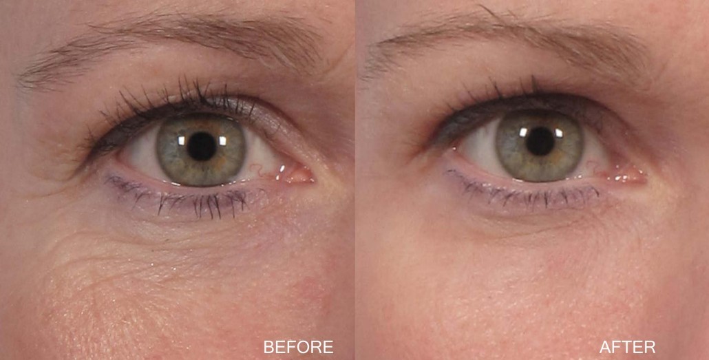 Dr. brett kotlus cosmetic oculoplastic lid resurfacing