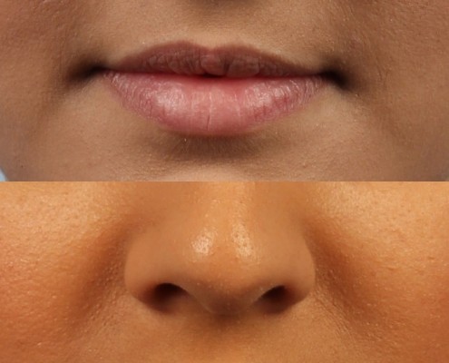Dr. brett kotlus cosmetic oculoplastic lip fillers