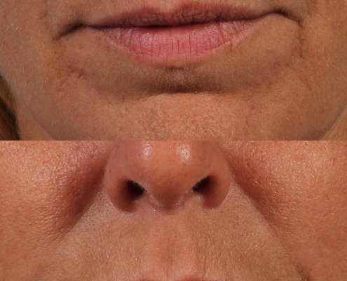 dr. brett kotlus juvederm lip enhancement