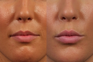 juvederm lips