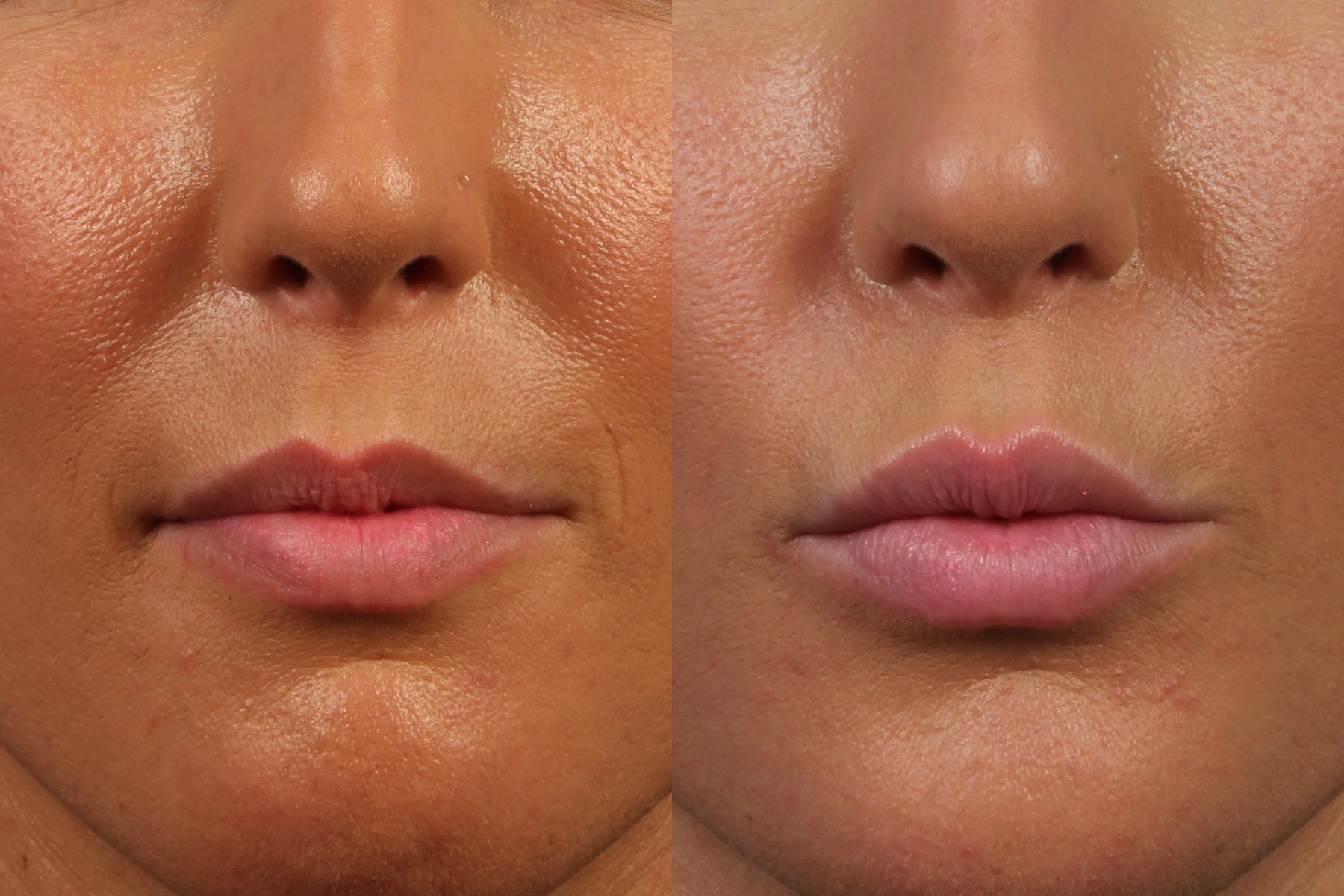 Avoid Lip Filler Mistakes | Dr. Brett Kotlus, Cosmetic Oculoplastic