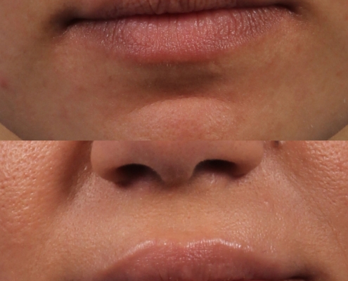 dr. brett kotlus filler lips nyc plastic