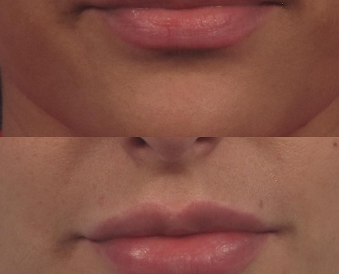 Dr. brett kotlus cosmetic oculoplastic lip plumping