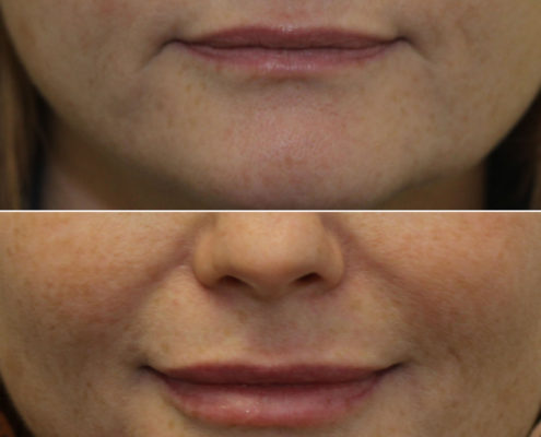 dr. brett kotlus lip enhancement