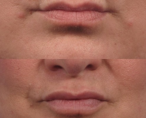 Dr. brett kotlus cosmetic oculoplastic lip fill