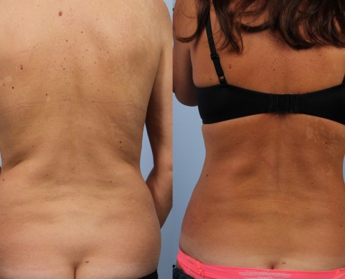 dr. brett kotlus hip liposuction ny