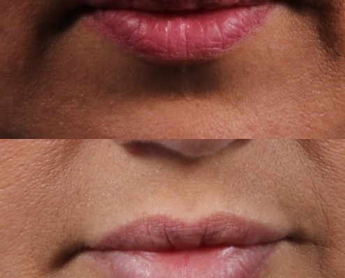 Dr. brett kotlus cosmetic oculoplastic lip fillers nyc