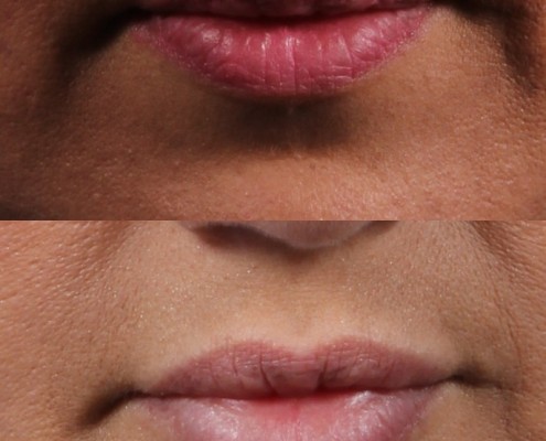 dr. brett kotlus lips juvederm