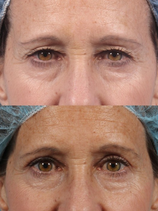 Dr. brett kotlus cosmetic oculoplastic blepharoplasty new york
