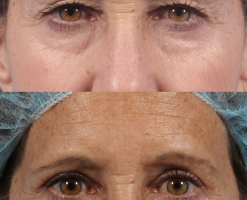 Dr. brett kotlus cosmetic oculoplastic blepharoplasty new york