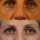 dr. brett kotlus eye lift ny