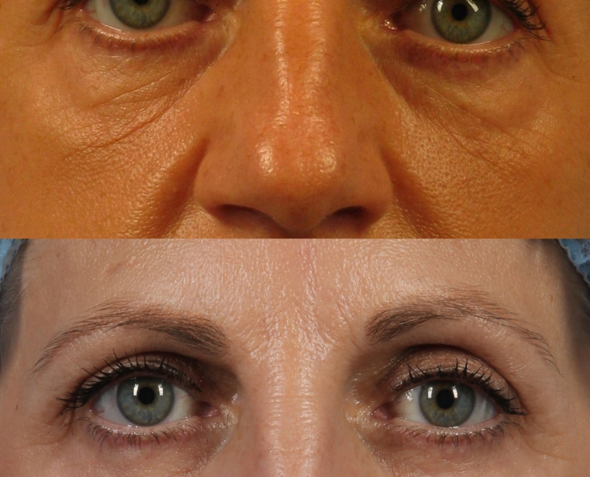 dr. brett kotlus eye lift ny