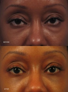 Dr. brett kotlus cosmetic oculoplastic lower eyelid lift