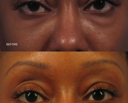 Dr. brett kotlus cosmetic oculoplastic lower eyelid lift