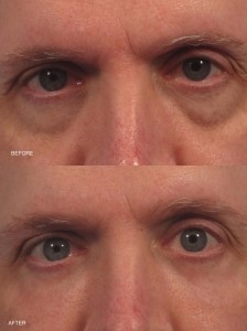 Dr. brett kotlus cosmetic oculoplastic fat grafting eyes
