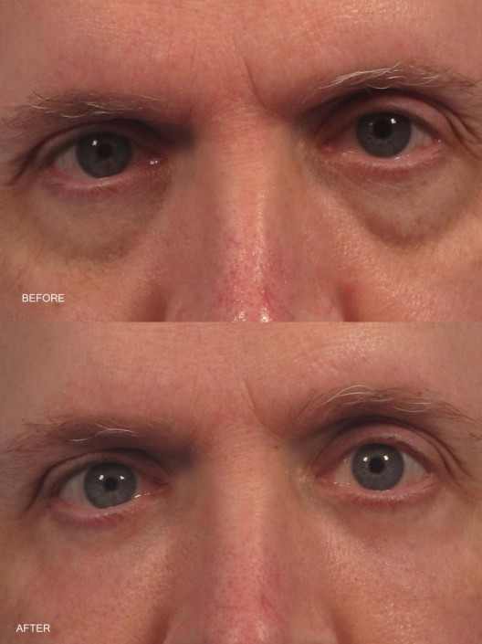 dr. brett kotlus fat transfer eyelid new york