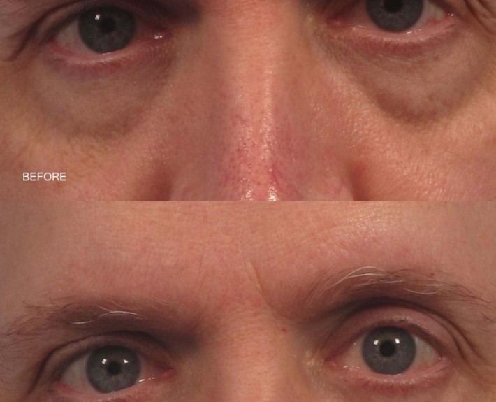 dr. brett kotlus fat transfer eyelid new york