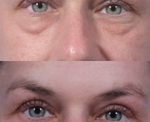 dr. brett kotlus lift kotlus eyelid