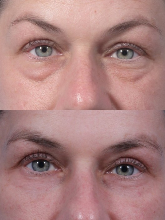 dr. brett kotlus lift kotlus eyelid