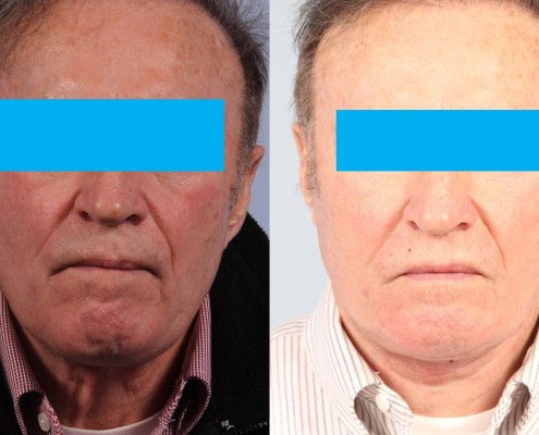 male neck lift nyc