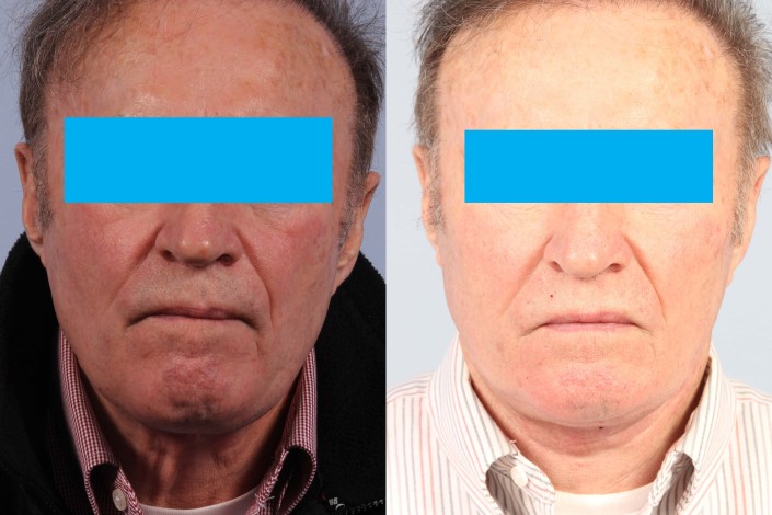 male neck lift nyc