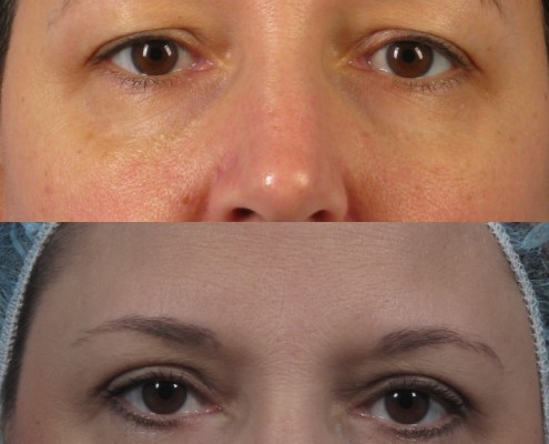 Dr. brett kotlus cosmetic oculoplastic blepharoplasty