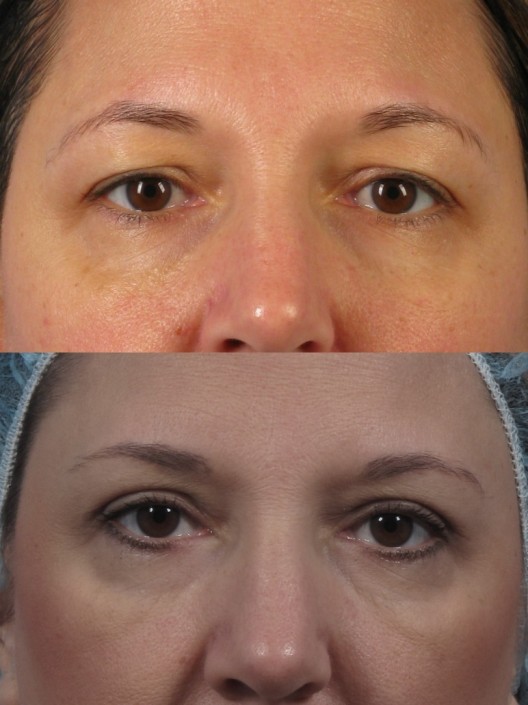 Dr. brett kotlus cosmetic oculoplastic blepharoplasty