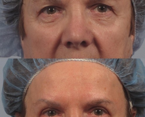 Dr. brett kotlus cosmetic oculoplastic eyelid lift