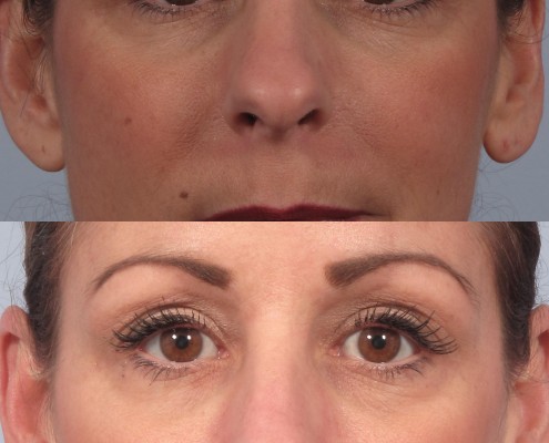 Dr. brett kotlus cosmetic oculoplastic rhinoplasty