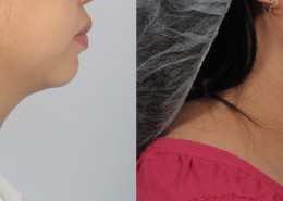 laser neck liposuction nyc